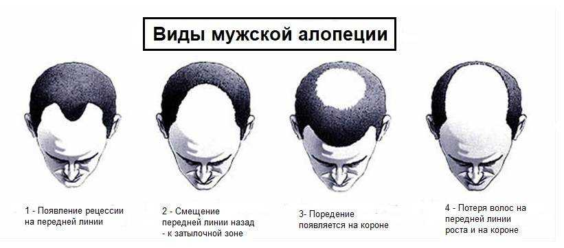Перхоть у ребенка 10-16 лет: причины и лечение