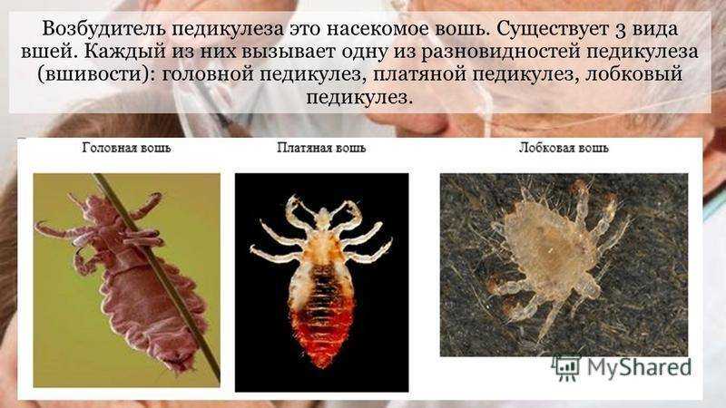 Как выглядят вши и гниды на волосах?