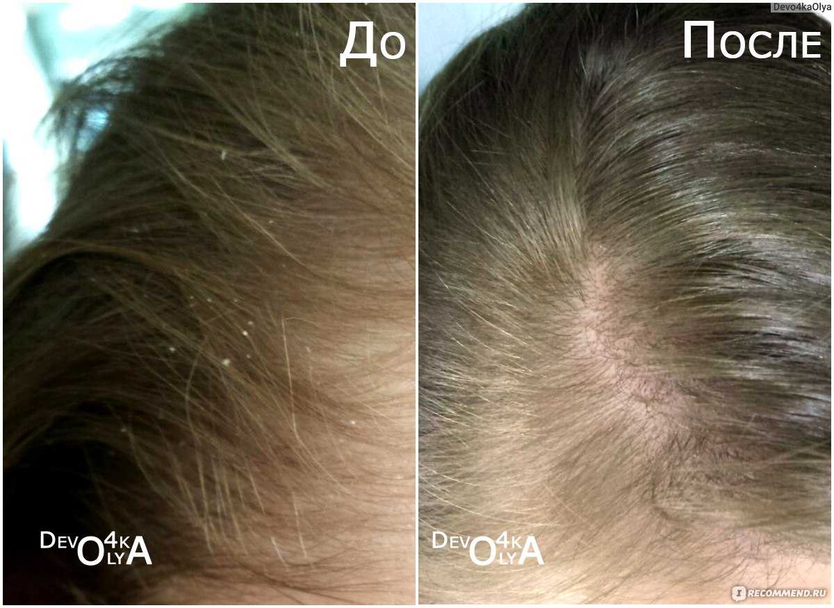Можно ли мыть голову хозяйственным мылом: мнение специалистов