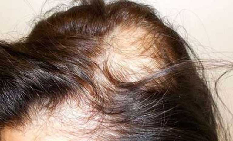 Бескапсульное наращивание волос: плюсы и минусы метода dream hairs, особенности способа без капсул, фото до и после, советы от стилистов гарньер