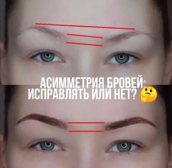 Асимметрия бровей: одна выше другой и как исправить