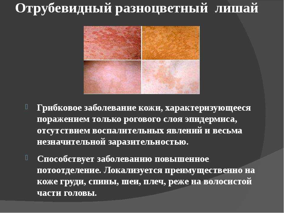 Лишай у человека | симптомы, причины и лечение