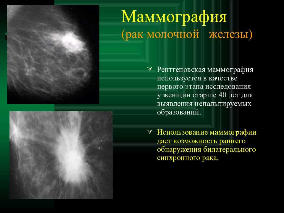 Рак молочной железы: первые признаки и симптомы рака груди, причины появления и стадии опухоли молочной железы | клиники «евроонко»