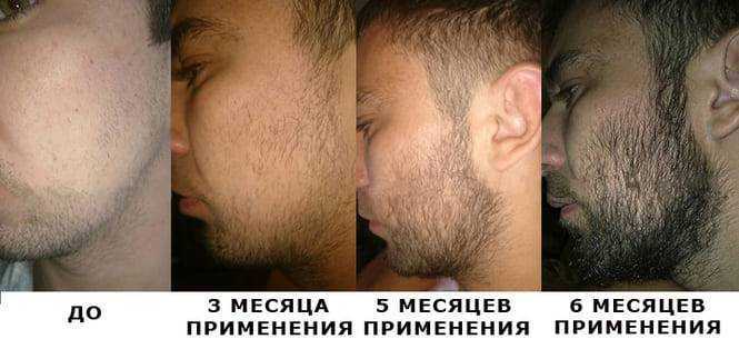 Волосы на лбу: маскировка проблемы и способы удаления
